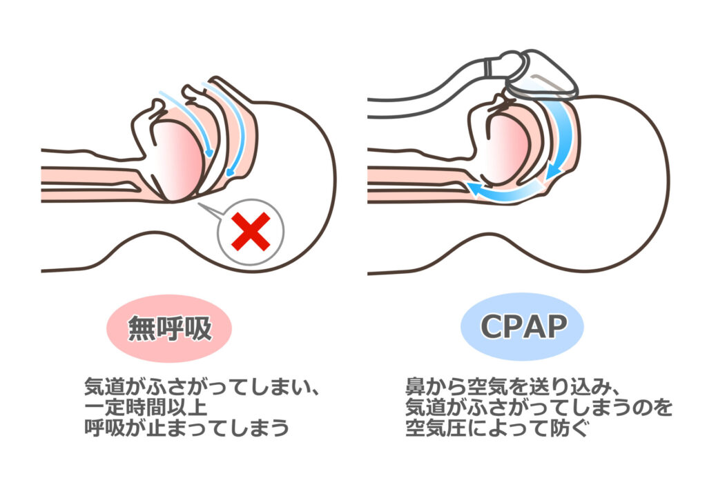 【イラスト】CPAPの図解